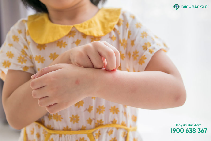 Dấu hiệu sốt xuất huyết ở trẻ thường xuất hiện các vết bầm tím trên da, phát ban