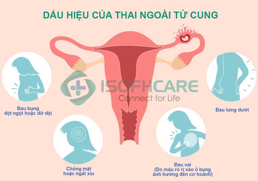 Thai ngoài tử cung - Biến chứng không mong muốn của viêm ống dẫn trứng