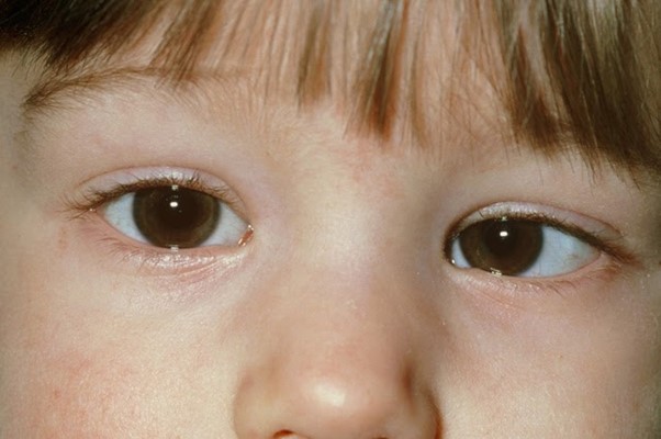 Dấu hiệu cho thấy trẻ bị lác mắt