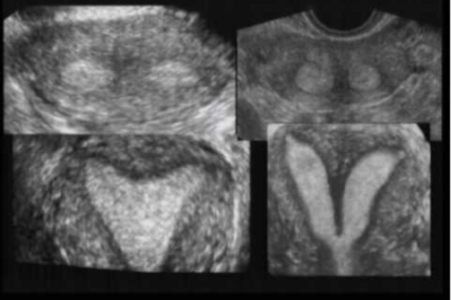 Hình ảnh dấu hiệu tử cung đôi trên siêu âm