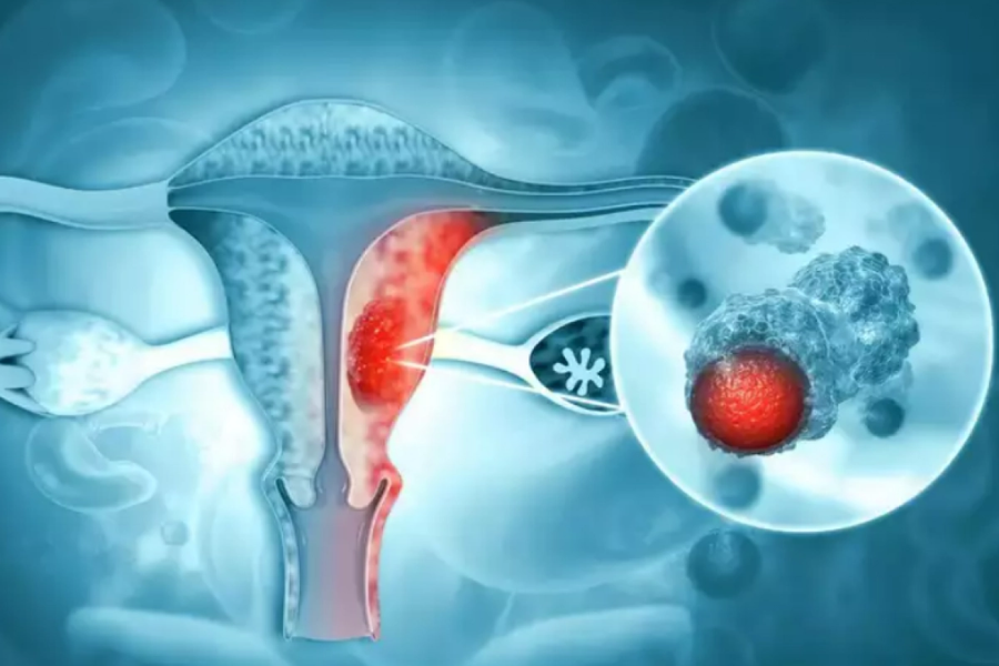 Ung thư cổ tử cung là bệnh ác tính thường gặp nhất ở đường sinh dục nữ