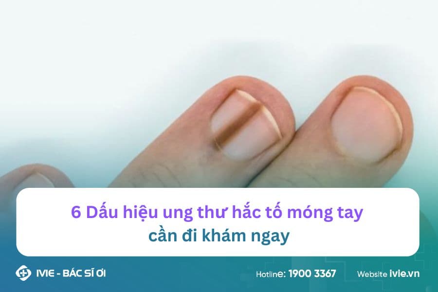 6 Dấu hiệu ung thư hắc tố móng tay cần đi khám ngay