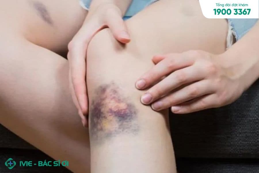 Xuất huyết dưới da là một dấu hiệu của ung thư máu