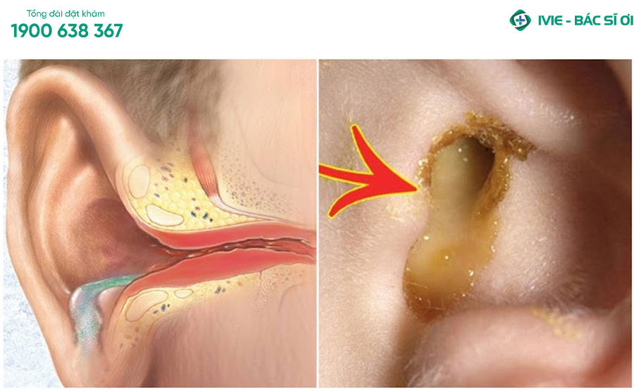 Viêm tai giữa cũng là một dạng của nhiễm trùng khiến cho trẻ bị nổi hạch sau tai