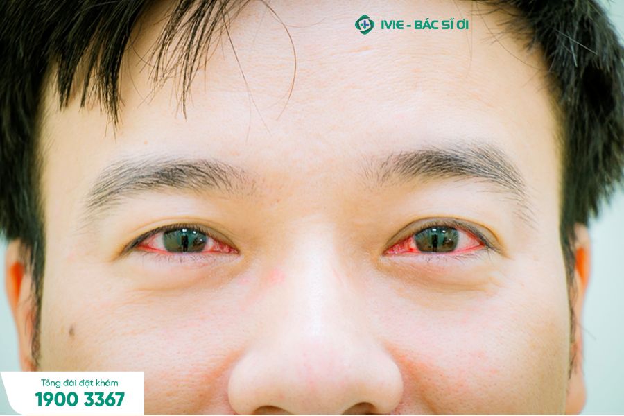 Đau mắt đỏ khám ở đâu Hà Nội?