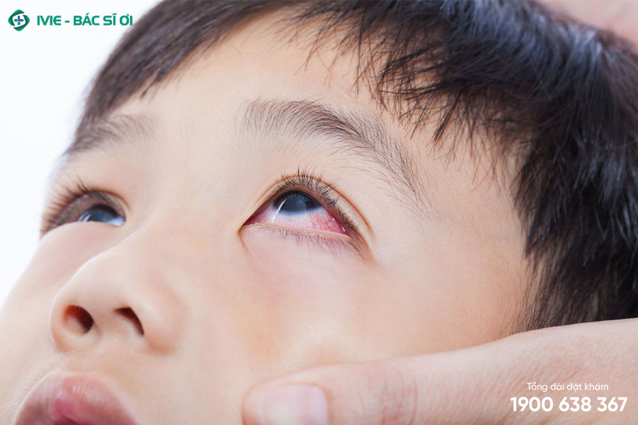 Đau mắt đỏ ở trẻ em có thể do viêm kết mạc do vi khuẩn