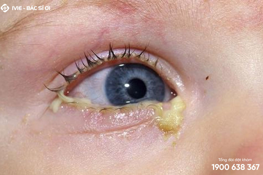 Mắt trẻ tăng tiết dịch vàng