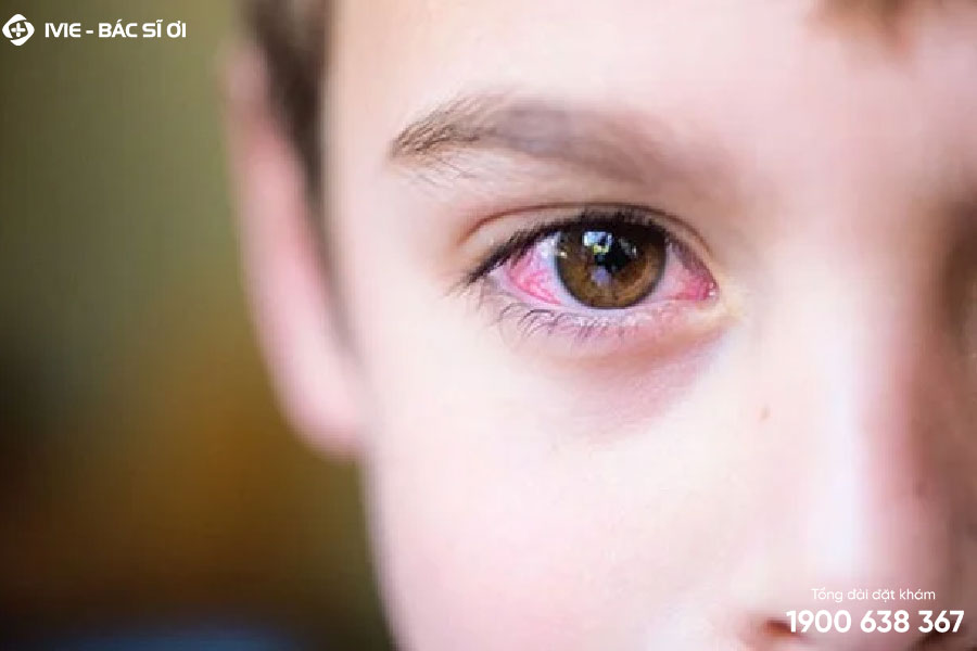 Đau mắt đỏ ở trẻ em là do đâu?