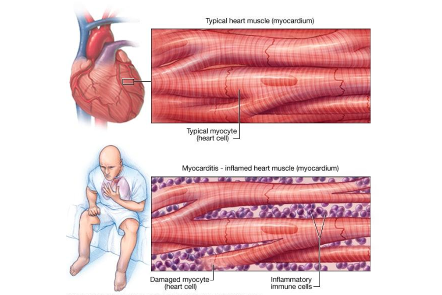 Đau ngực là triệu chứng thường gặp trong viêm màng ngoài tim cấp