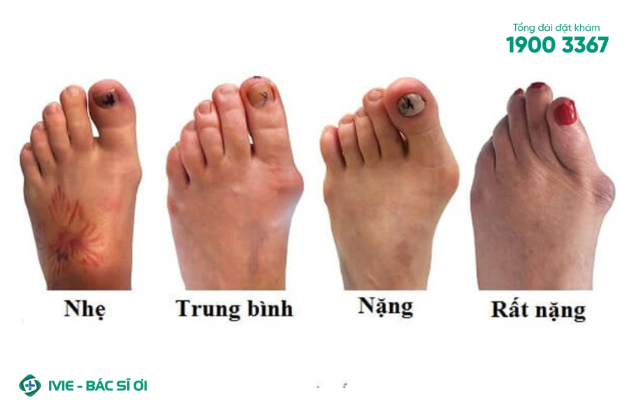 Đau xương bàn chân là biểu hiện của bệnh Gout