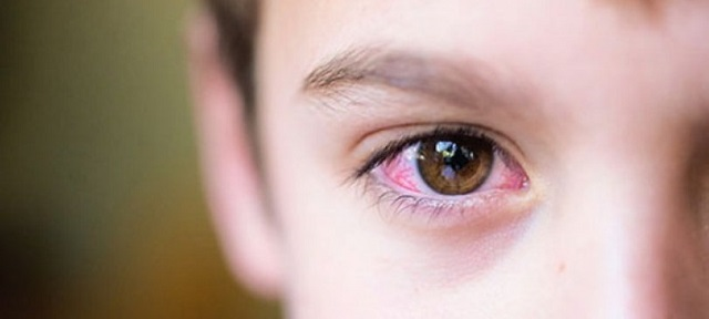 Đau mắt đỏ ở trẻ em bố mẹ không nên lơ là