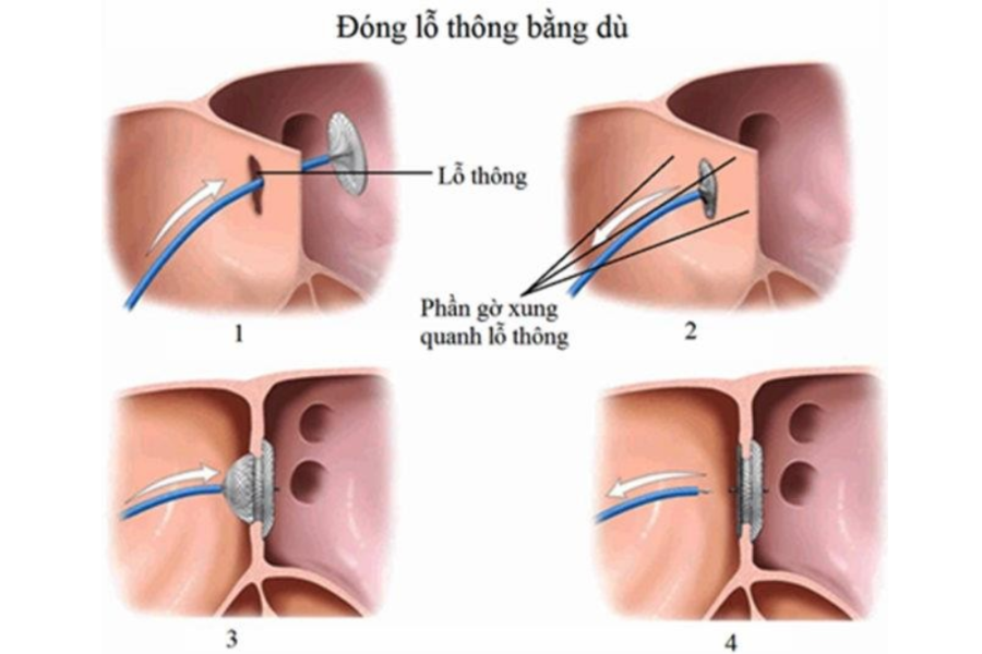 Bít lỗ thông liên nhĩ bằng dù nhân tạo