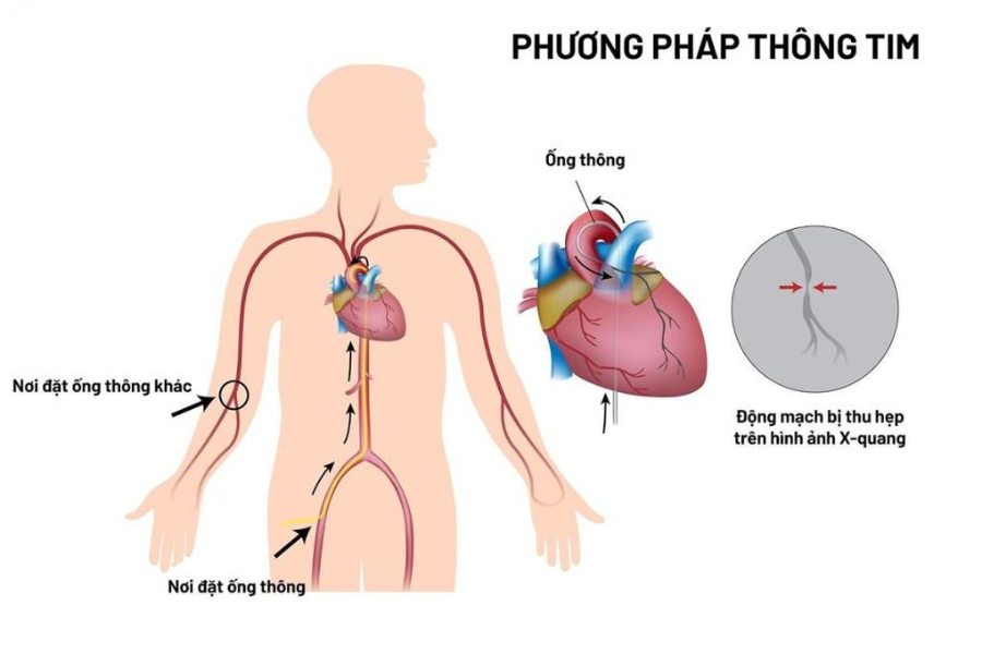 Kỹ thuật thông tim trên người lớn và trẻ em về cơ bản không có sự khác biệt.