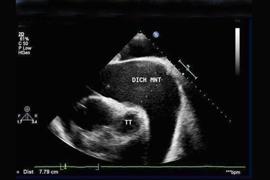 Dịch màng ngoài tim trên siêu âm, dấu hiệu có thể gặp trong viêm màng ngoài tim cấp