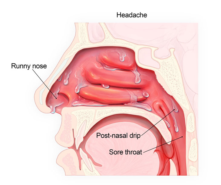 Dịch mũi chảy xuống họng có thể do cảm lạnh gây ra?
