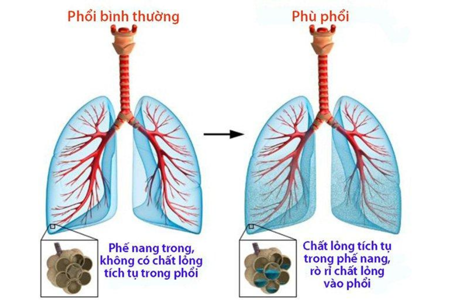 Dịch và chất lỏng tích tụ vào phổi gây phù phổi