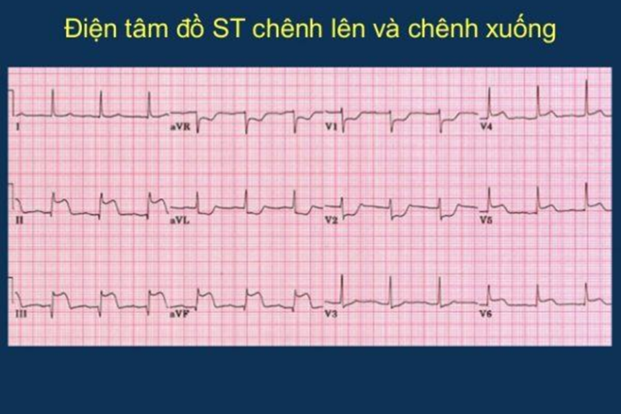Điện tâm đồ ST chênh lên tại các chuyển đạo D2,D3, aVF, chênh xuống ở các chuyển đạo soi gương gợi ý nhồi máu cơ tim vùng sau dưới