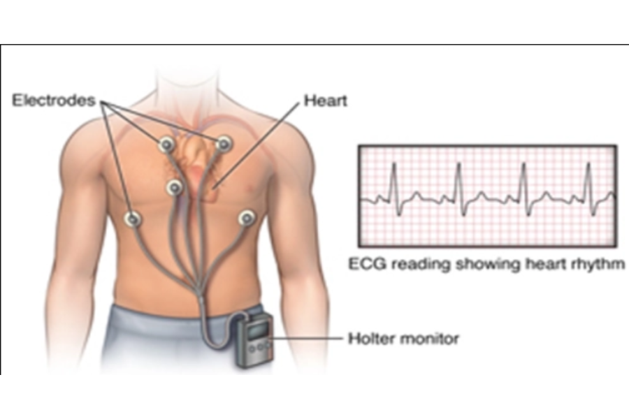 Holter điện tâm đồ giúp theo dõi mọi biến đổi nhịp tim trong 24h, từ đó xác định được các biến đổi nhỏ nhất của nhịp tim người bệnh