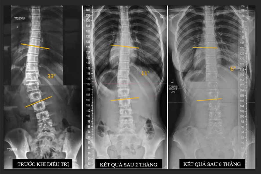 Điều trị cong vẹo cột sống tại phòng khám SCC