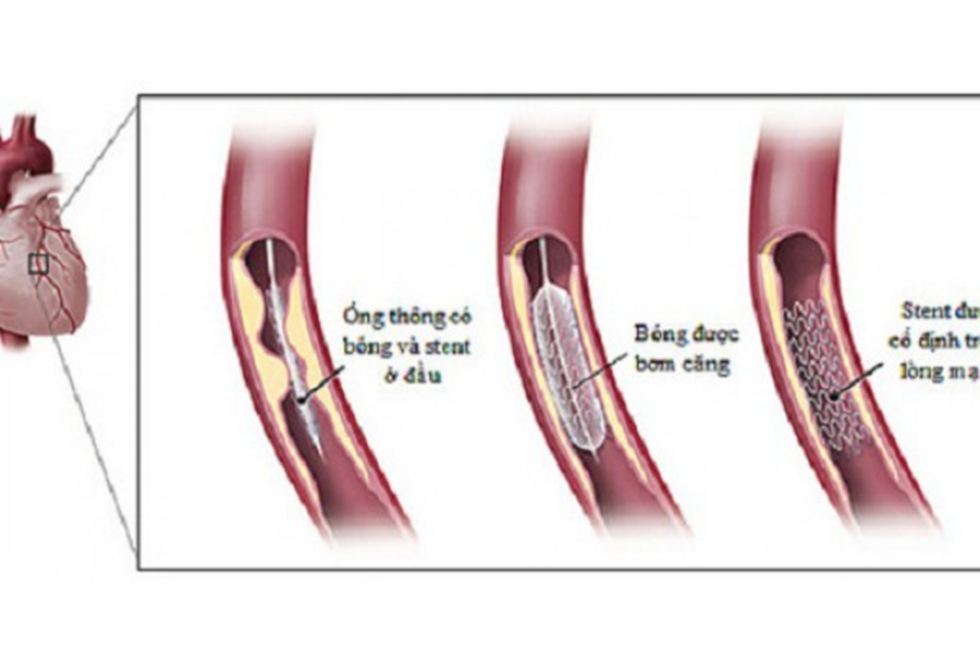 Điều trị bằng phương pháp nong và đặt stent