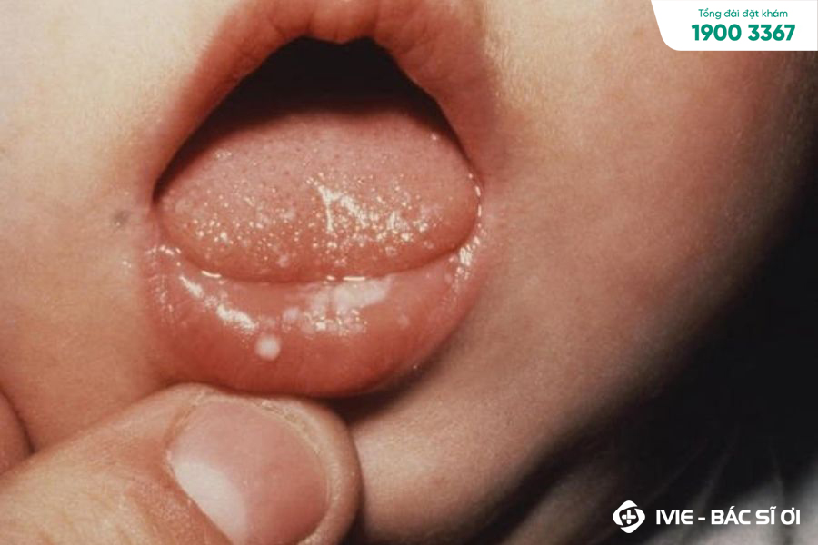 Nấm miệng ở trẻ 2 tuổi có nhiều triệu chứng khác nhau
