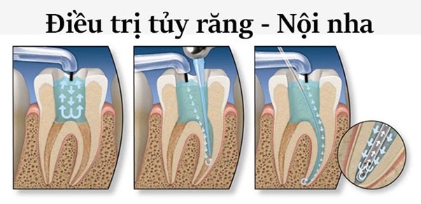 Điều trị tủy răng- Nội nha