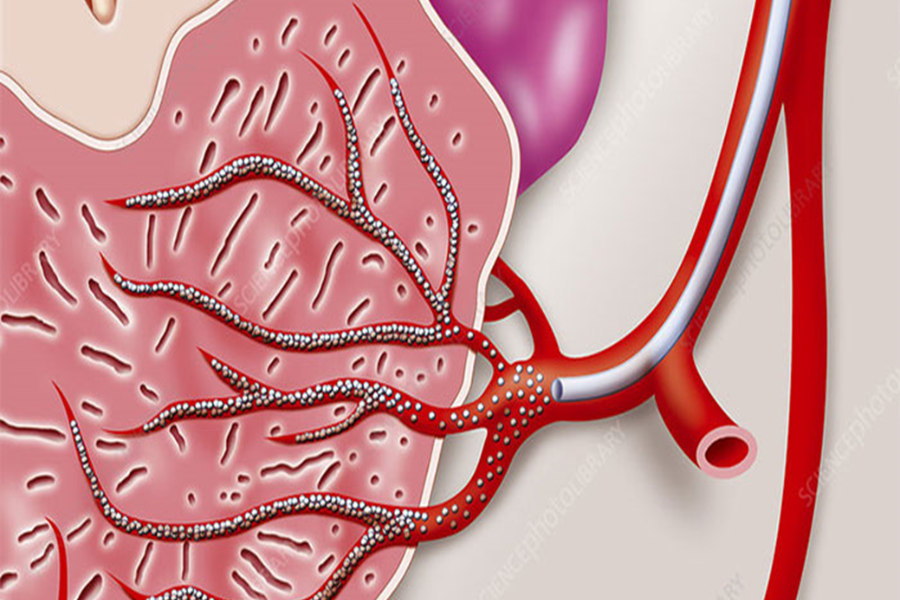 Thủ thuật nút mạch tương đối an toàn
