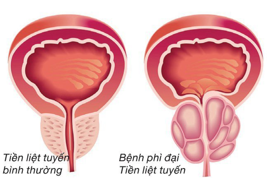 Hiện nay điều trị nội khoa được xem là nền tảng của điều trị bệnh lý này