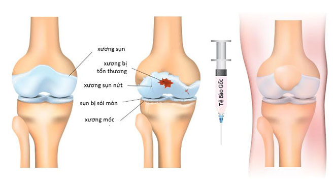 Điều trị viêm khớp gối