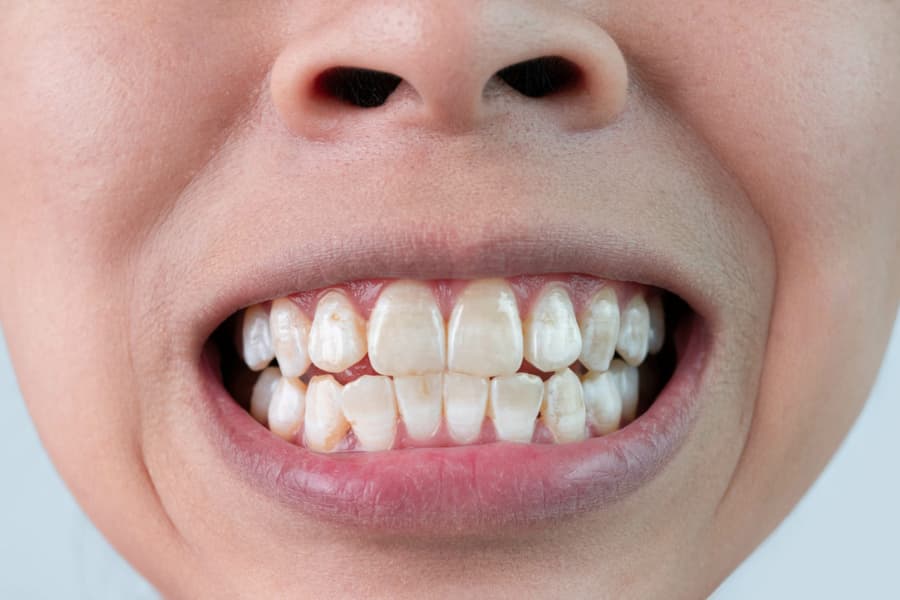 Nguyên nhân gây đốm trắng trên răng