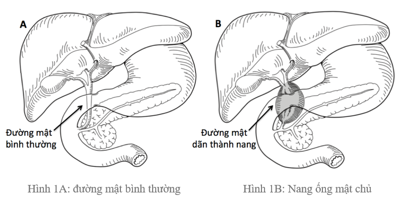 PHẪU THUẬT NỘI SOI MỘT ĐƯỜNG RẠCH QUA RỐN ĐIỀU TRỊ NANG ỐNG ...