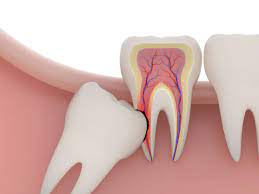 Những tác hại của răng khôn mọc lệch không nên chủ quan