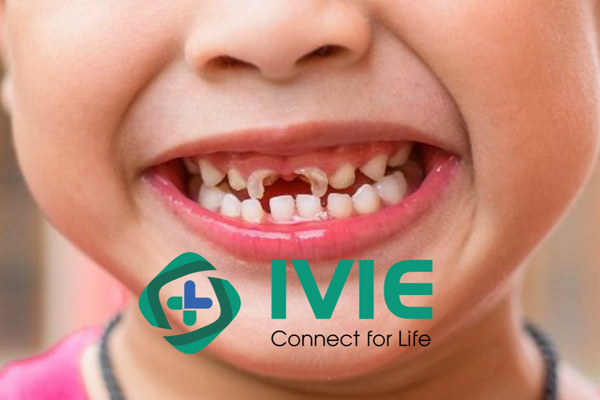 Những giải pháp dự phòng sâu răng phổ biến hiện nay ở trẻ em