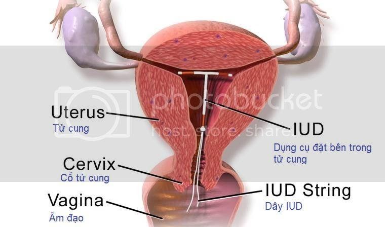 Dụng cụ tử cung (DCTC) chứa đồng tránh thai bằng cách nào?