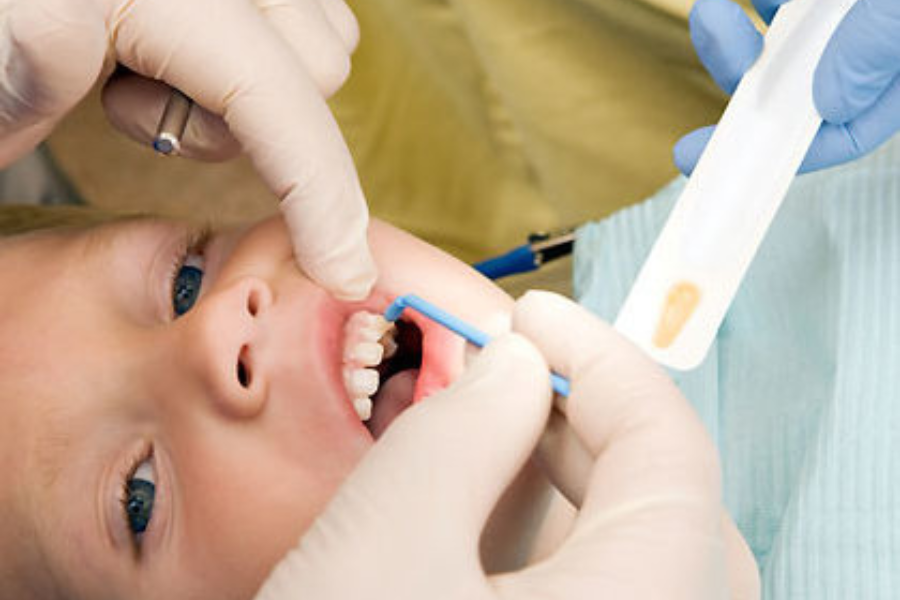 Fluoride dự phòng sâu răng ở trẻ