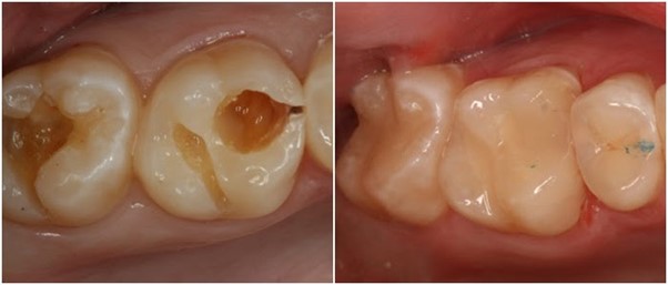 Giai đoạn sâu ngà răng