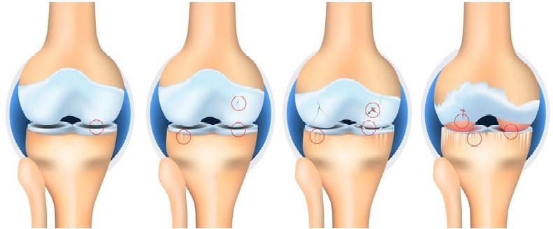Giai đoạn thoái hóa khớp gối