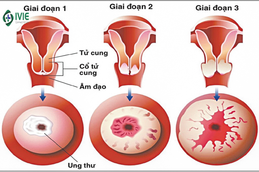 Các giai đoạn của ung thư cổ tử cung