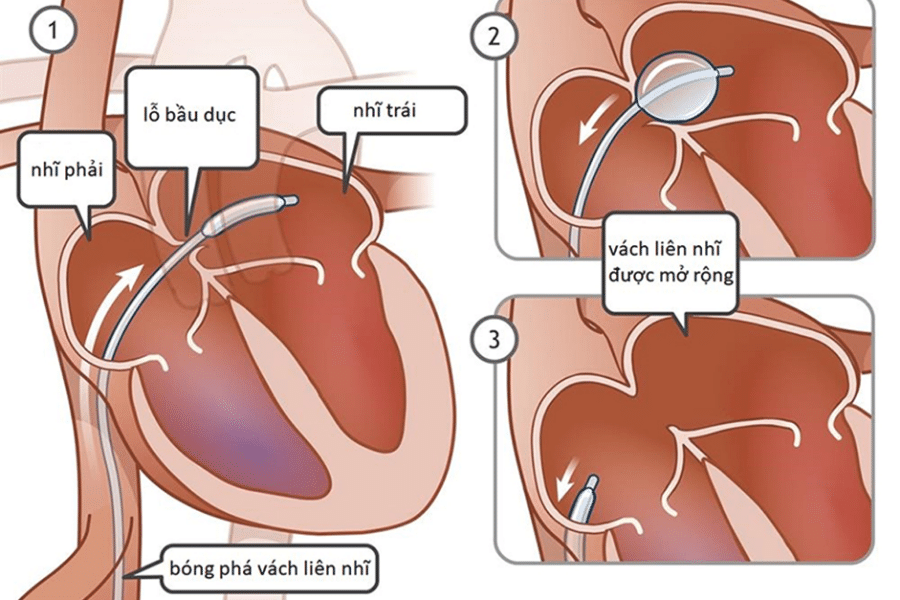 Hình ảnh giải phẫu tim Bệnh viện Hữu nghị Việt Đức