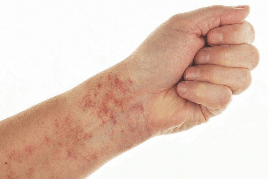 Xét nghiệm HIT-IgG phát hiện giảm tiểu cầu.