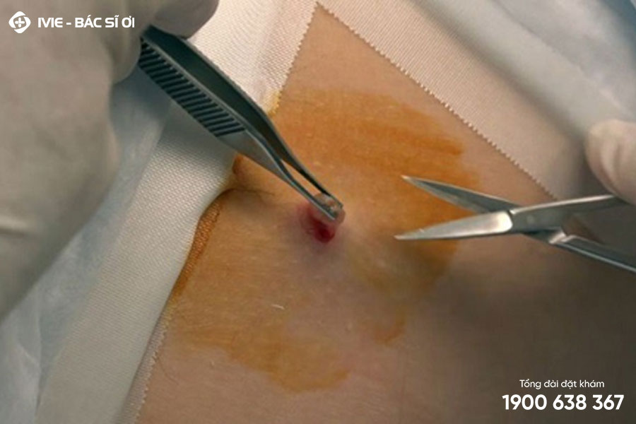 Phẫu thuật cắt mụn thịt là phương pháp trị mụn thịt hiệu quả