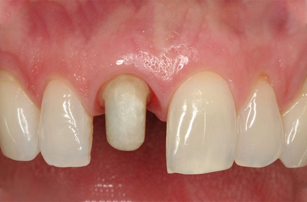Hậu quả của việc bọc răng sứ