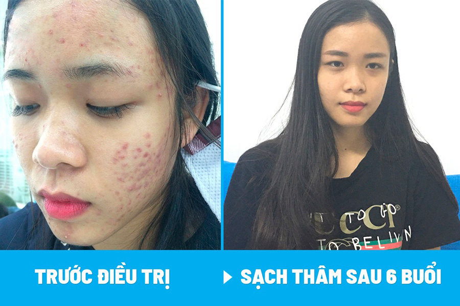 Hình ảnh bệnh nhân trước và sau khi điều trị nám da tại Phòng khám Da liễu Hà Nội