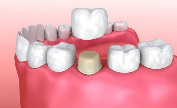 Hình ảnh bọc răng sứ