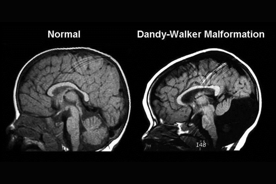 Hội chứng Dandy-Walker là một dị tật não bẩm sinh