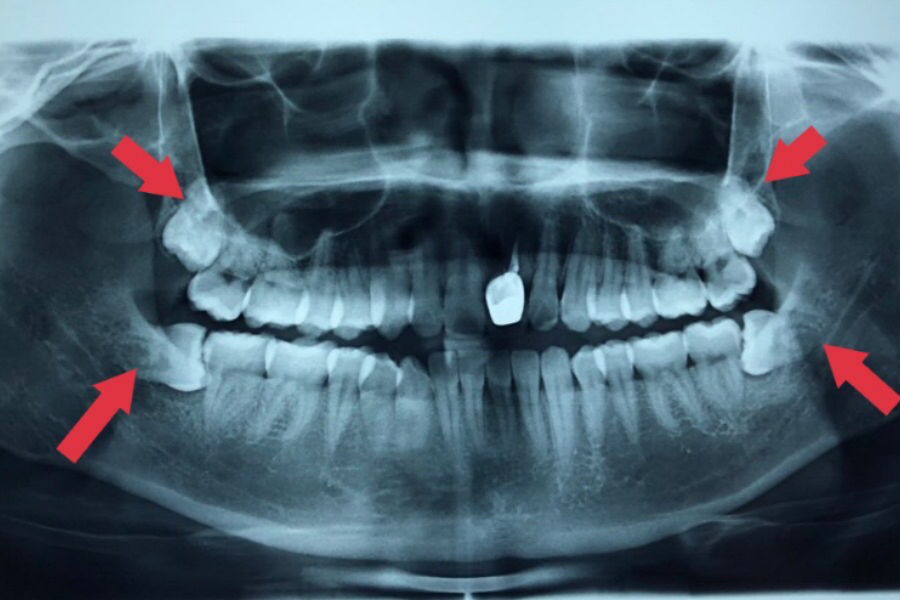 Mũi tên đỏ chỉ hình ảnh răng khôn (răng hàm số 8)