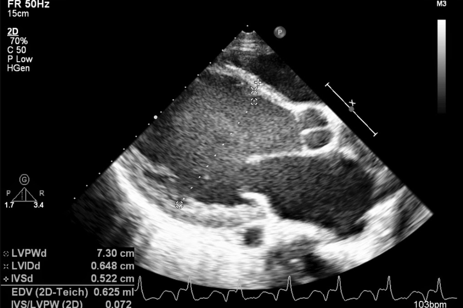 Hình ảnh thất trái lớn (đường kính 73mm (bình thường 48-52mm)) của một người bệnh mắc bệnh cơ tim giãn