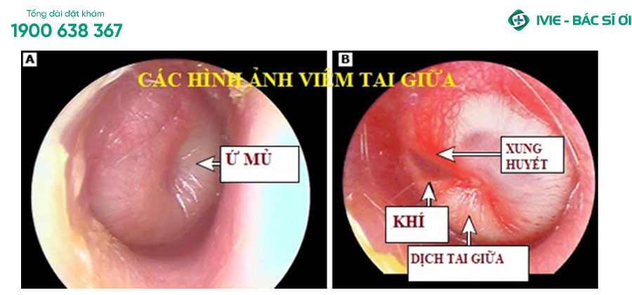 Hình ảnh viêm tai giữa với các tổn thương viêm