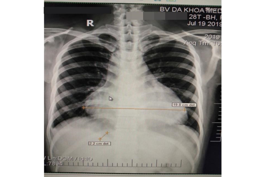 Hình ảnh tràn dịch màng tim trên Xquang (đường kính 19.8cm)