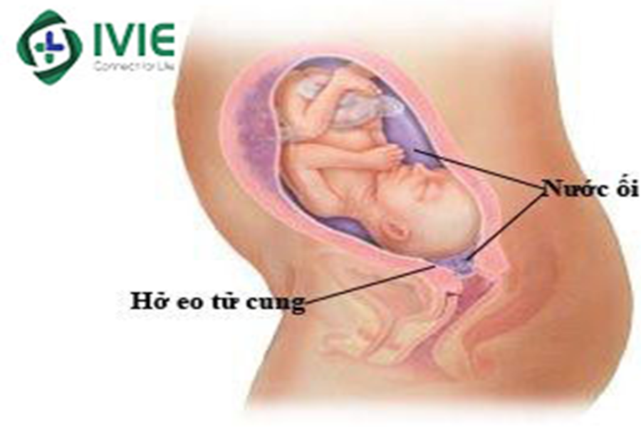 Hở eo tử cung là một trong những nguyên nhân hàng đầu gây ra sảy thai và sinh non 
